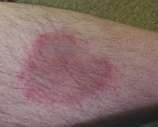 Wanderröte als Spätfolge eines Zeckenstichs mit Borrelioseinfektion (Foto: Jost Jahn)